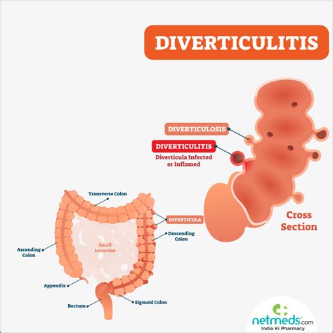What Does Diverticulitis Look Like