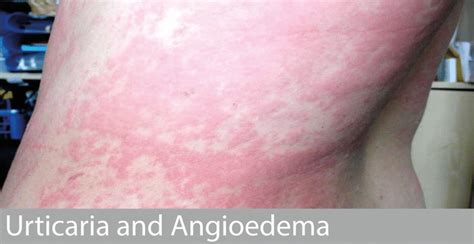 Urticaria & Angioedema | Allergy Doctor | Dr David Orton
