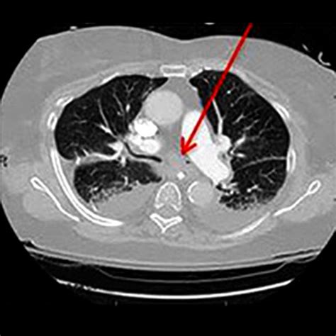 Chest computed tomography (CT) descending axial views demonstrate... | Download Scientific Diagram