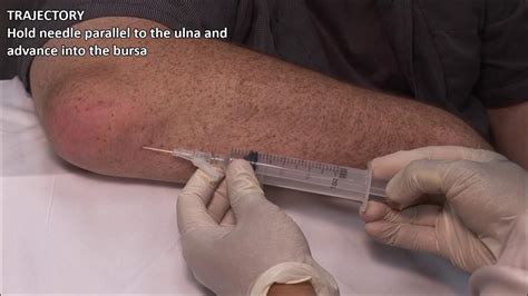 Olecranon Bursitis - Aspiration and Injection - In Vivo Series - YouTube