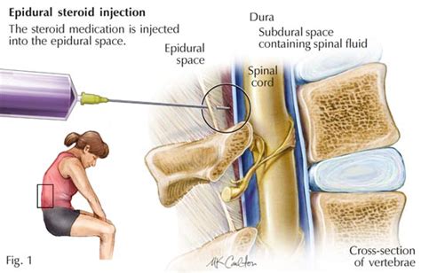 Epidural Steroid Injection - Pomona Pain Management Doctor | epidural ...