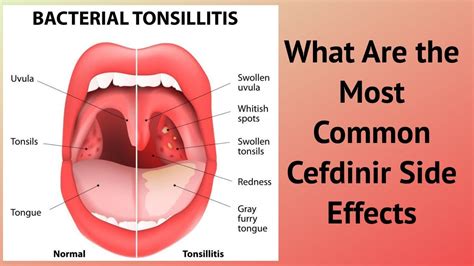 What Are the Most Common Cefdinir Side Effects - YouTube