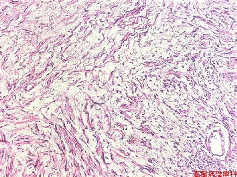 Neurilemmoma; Neurinoma; Schwannoma; Neurilemmosarcoma; Malignant ...