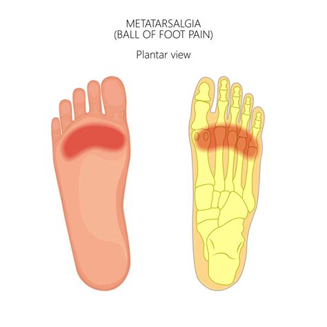 What Is Metatarsalgia? | Applied Biomechanics Orthotics & Bracing Guelph