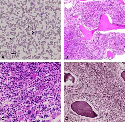 (A) Peripheral blood smear (Leishman stain 200Â) showing tear drop ...