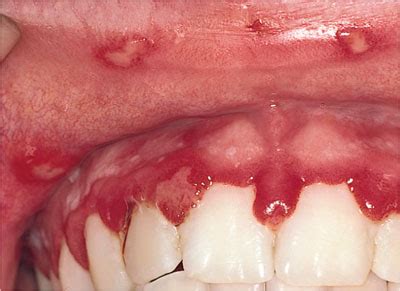 4: Infections of the Oral Mucosa | Pocket Dentistry