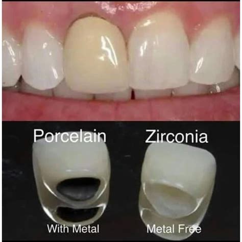 Full Ceramic Zirconia, For Filling at Rs 8000/piece in Kolkata | ID ...