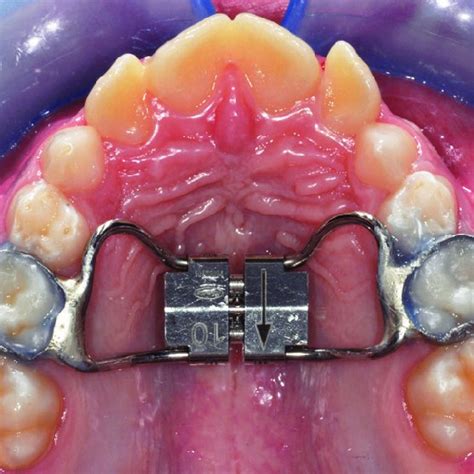 Conventional rapid maxillary expander. | Download Scientific Diagram