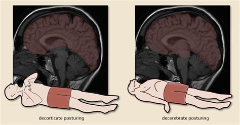 Decorticate and decerebrate posturing | STROKE MANUAL