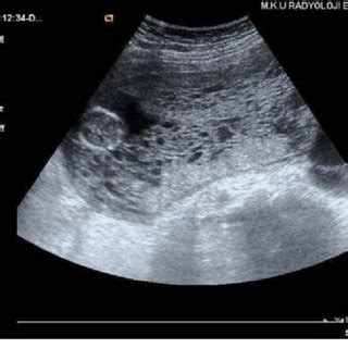 Case 2: Molar placenta and fetus | Download Scientific Diagram