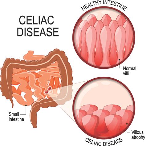 Coeliac Disease | Gluten Sensitive Enteropathy | Symptoms and Treatment