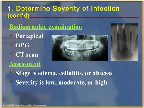 Odontogenic infections