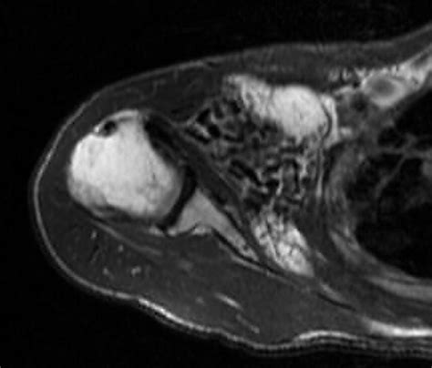 Synovial chondromatosis -MRI - Sumer's Radiology Blog