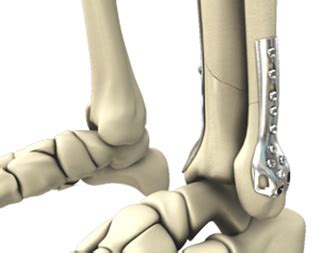 Open Reduction and Internal Fixation Oshkosh, WI | Ankle Fracture Green Bay, Appleton, WI