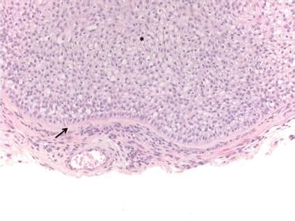 Trichilemmoma | MDedge Dermatology