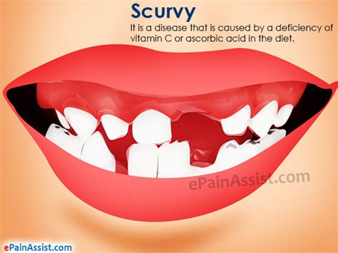 Scurvy|Causes|Signs|Symptoms|Treatment|Home Remedies|Prevention