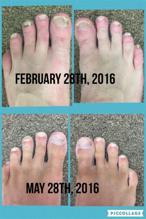 Before and after pics using Terbinafine – Toenail Fungus