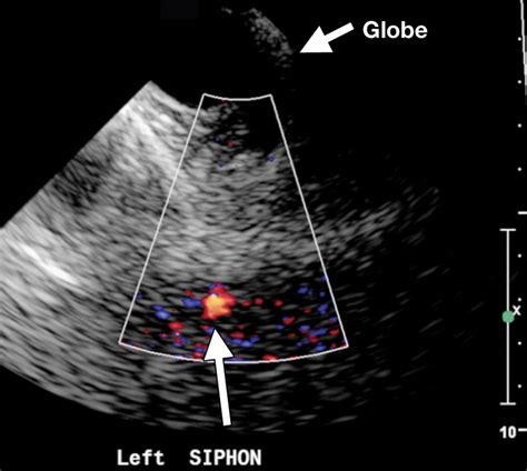 Advances in Transcranial Doppler US: Imaging Ahead | RadioGraphics