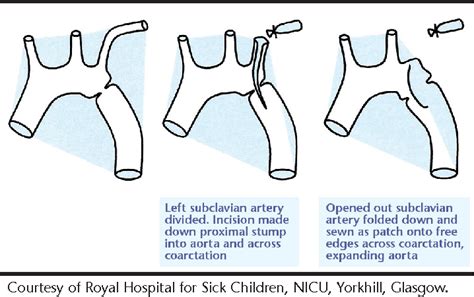 Figure 3 from Coarctation of the aorta: a case presentation. | Semantic Scholar