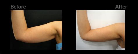 Laser Liposuction & Skin Tightening - Before and after. PHIclinic.com | Laser liposuction ...