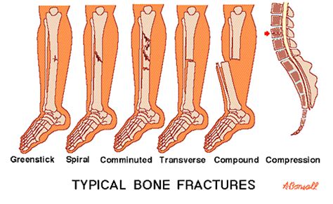 Louisville's Kevin Ware's Terrible Leg Injury - Celebrity Diagnosis