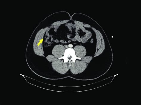 Normal appendix tissue on CT scan CT: Computed tomography | Download ...