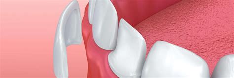 Veneers vs. Dental Bonding: Pros and Cons Compared | Cosmetic Dentistry Mount Pleasant SC