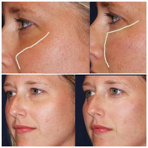 Dermal Fillers Charlotte, NC at The Skin Center by CPS