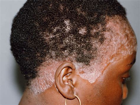 Scalp Psoriasis - Causes, Symptoms, Treatment, Pictures, Remedies | Diseases Pictures