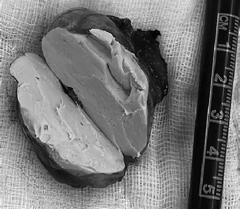 -The intact dermoid cyst postoperatively. Figure 4 -The dermoid cyst ...