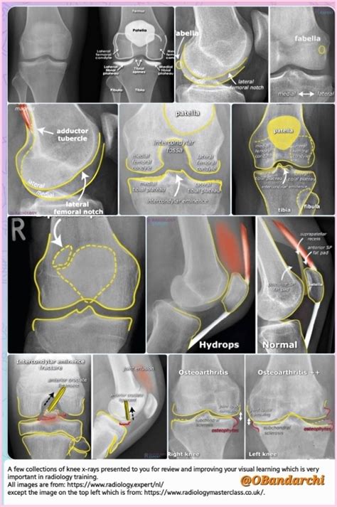 Adductor Tubercle X Ray