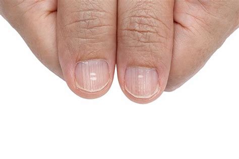 Do You Have Dark Vertical Lines On Nails? What Are They Actually ...