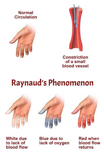 Painted fingers or Raynaud's? - MEDizzy Journal