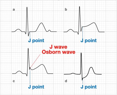 The Diagram Shows Qrs Which Term Describes Point T