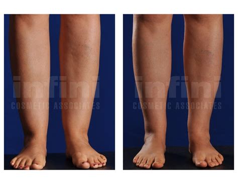 Calf and Ankle Liposuction Before and After | Infini Phoenix Liposuction