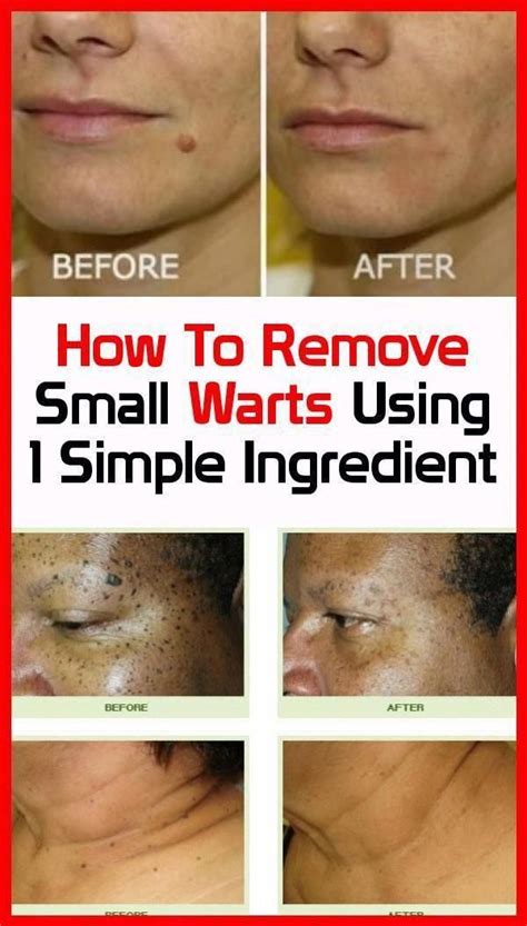 How To Remove Warts Around Neck - HOWTOREMVO