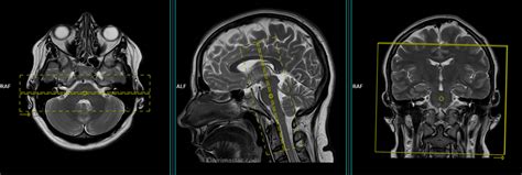 Internal Auditory Meatus(IAMS) MRI Protocols and Planning | Indications for MRI IAM'S Scan