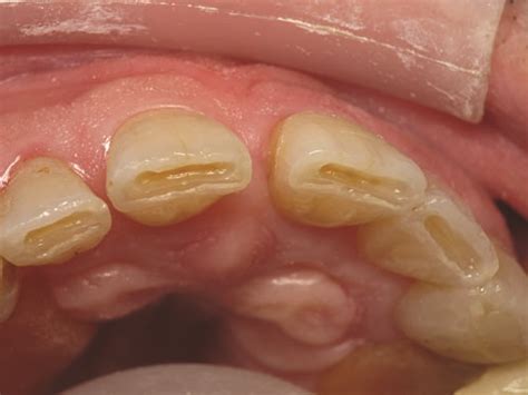 Show Your Work: Treating Incisal Edge Wear by Dr. Marvin Fier - Dentaltown