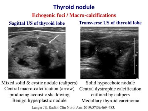 Ultrasound of thyroid nodules