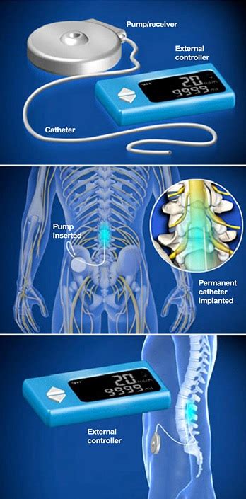 Pain Stops Here: Intrathecal Pump Implant - The Southeastern Spine Institute