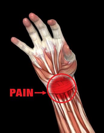 Wrist Sprain Anatomy