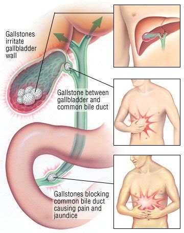 Bile Duct Diseases Guide: Causes, Symptoms and Treatment Options