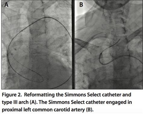 Penumbra System® for Intracranial Mechanical Thrombectomy - Endovascular Today