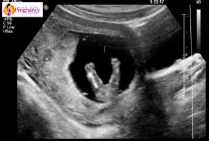 13 wks ultrasound