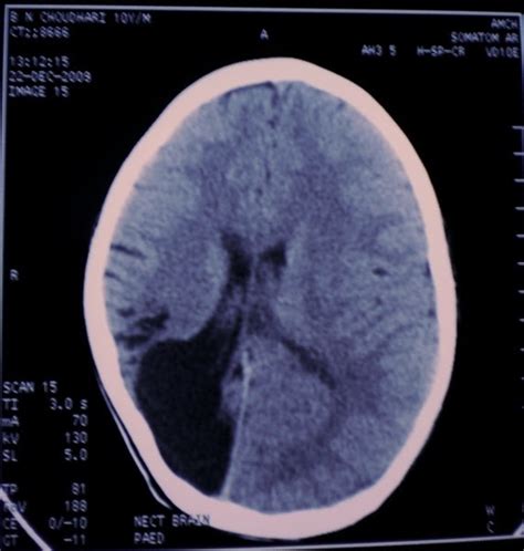 IRRADIATED - Radiology: SCHIZENCEPHALY - Two cases