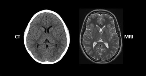MRI Vs CT Scan Difference