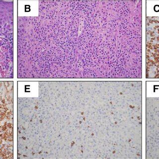 Histologic findings of cutaneous T-cell lymphoma. (A) Atypical lymphoid... | Download Scientific ...