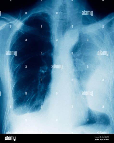 Pleurisy. Coloured X-ray of the lungs of a patient with pleurisy ...