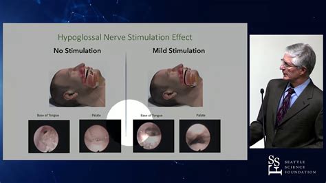 Hypoglossal Nerve Stimulation For Select Sleep Apnea Patients - John T. Parker, MD - YouTube