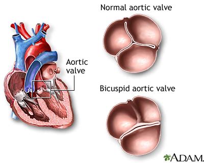 Bicuspid aortic valve: MedlinePlus Medical Encyclopedia Image